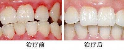 牙周治療案例5